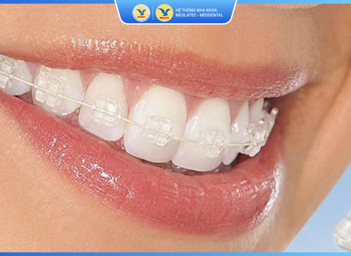 Niềng răng mắc cài sứ 